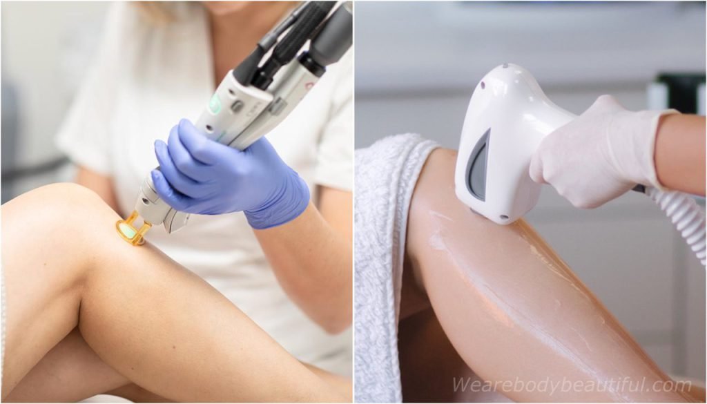 IPL vs. Laser