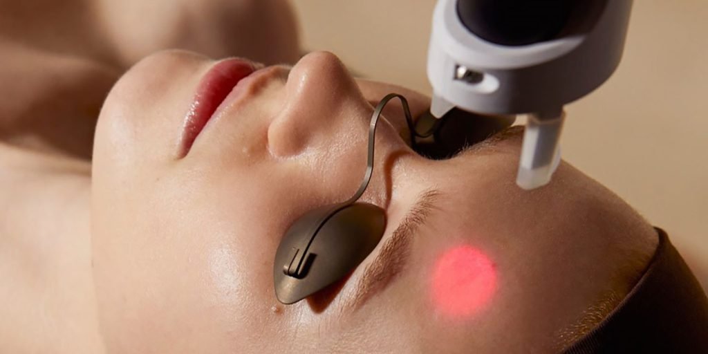 What is Laser Carbon Peel? The Ultimate Guide