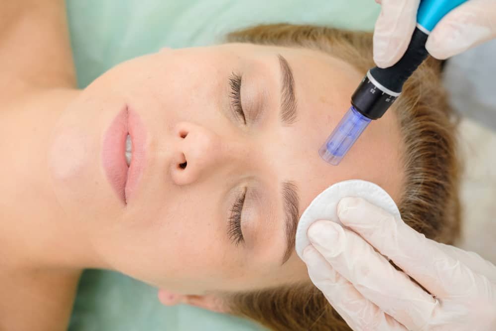 What is Microneedling